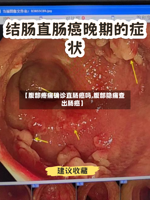 【腹部疼痛确诊直肠癌吗,腹部隐痛查出肠癌】