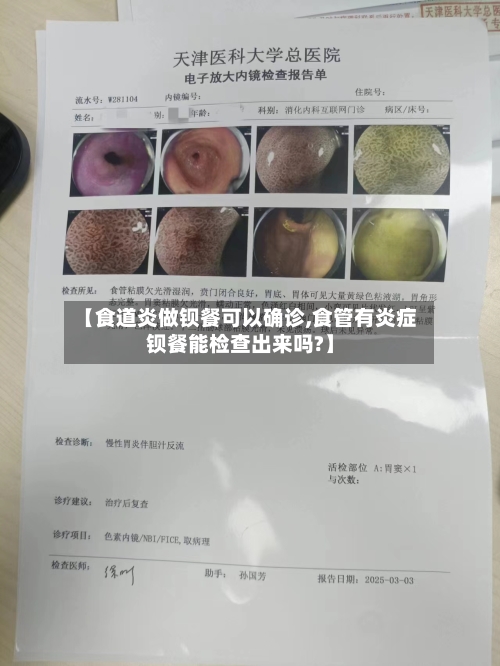 【食道炎做钡餐可以确诊,食管有炎症钡餐能检查出来吗?】