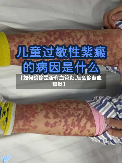 【如何确诊是否有血管炎,怎么诊断血管炎】-第2张图片