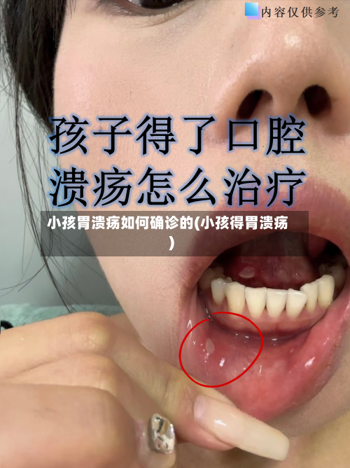小孩胃溃疡如何确诊的(小孩得胃溃疡)-第2张图片